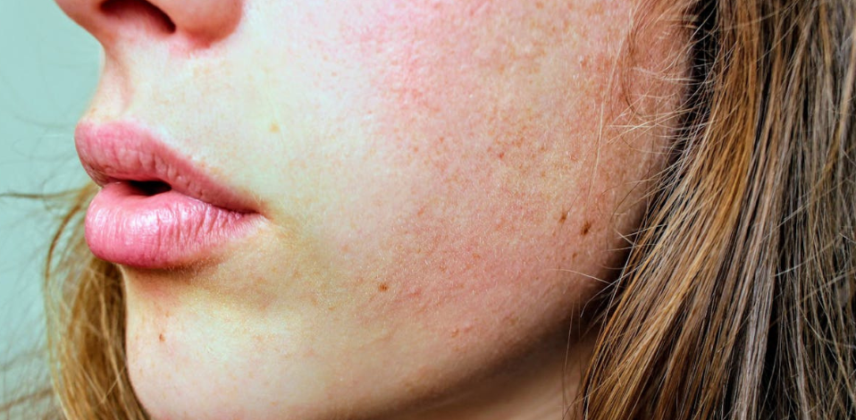 Close-up of a woman’s face with visible dry skin patches