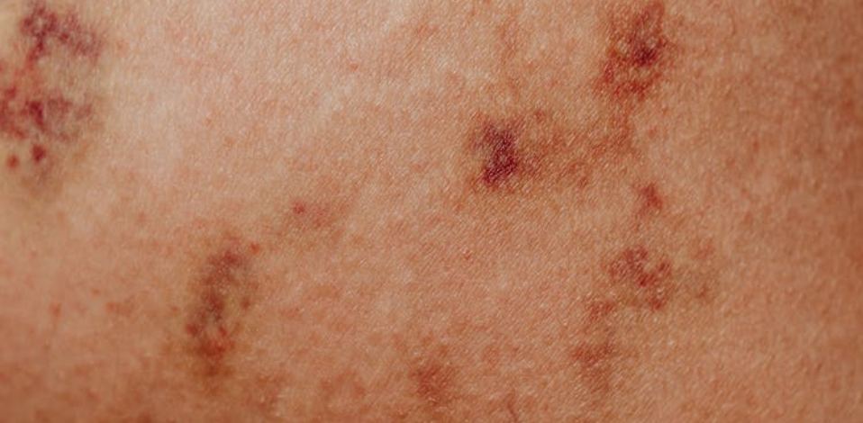 Close-up of skin showing redness and inflammation, a common symptom of eczema.