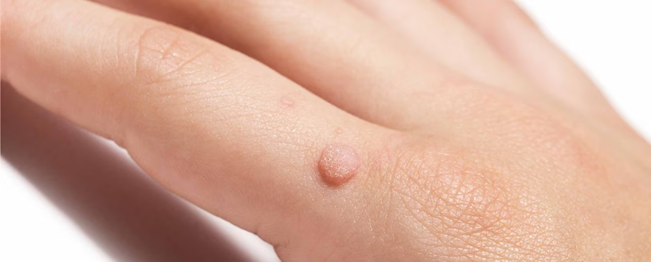 why are warts hard to treat