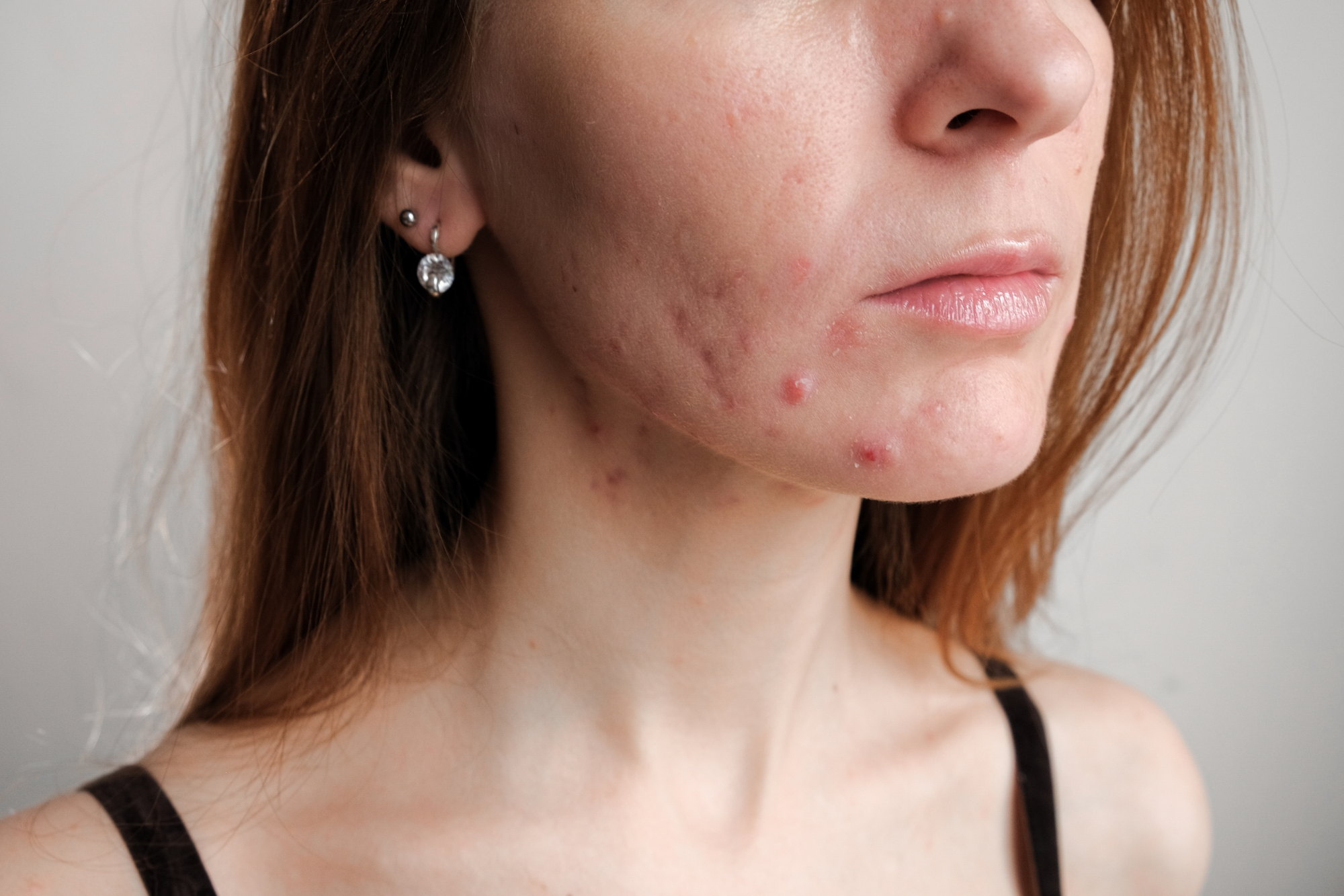 Accutane for severe acne